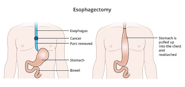 Esophagectomy