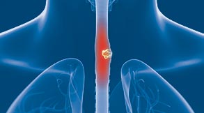 Esophageal Cancer Treatment in Tampa, FL