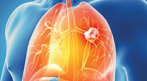 Lung Cancer Treatment in Tampa, FL