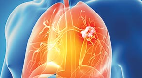 Lung Cancer Treatment in Tampa, FL