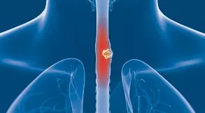 Esophageal Cancer Treatment in Tampa, FL